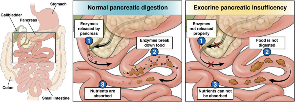 Savvy Updates, 7/24/23: Exocrine Pancreatic Insufficiency, Dahlias & T1D, Volagidemab (GCGR), Pharma Sues Medicare, CODEX the Gut, Tight Control OK for Retinopathy, Early Risers vs. Night Owls, Overcoming Burnout